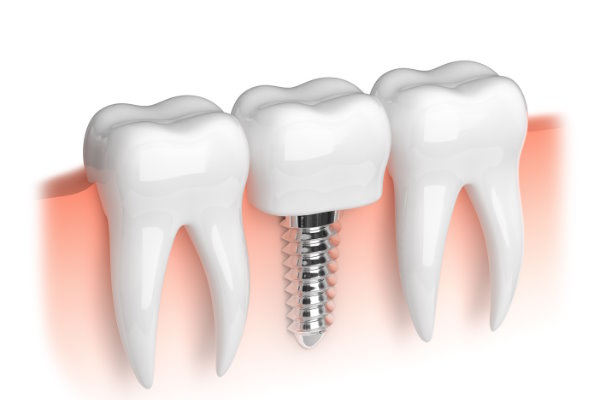 Grand Rapids - Dental Implants - Firlik Family Dentistry